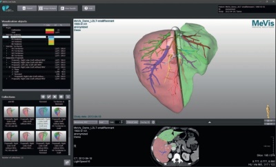 MeVis Liver Suite